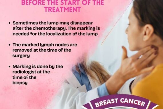 marking of the lump and the lymph nodes is important before the start of the treatment